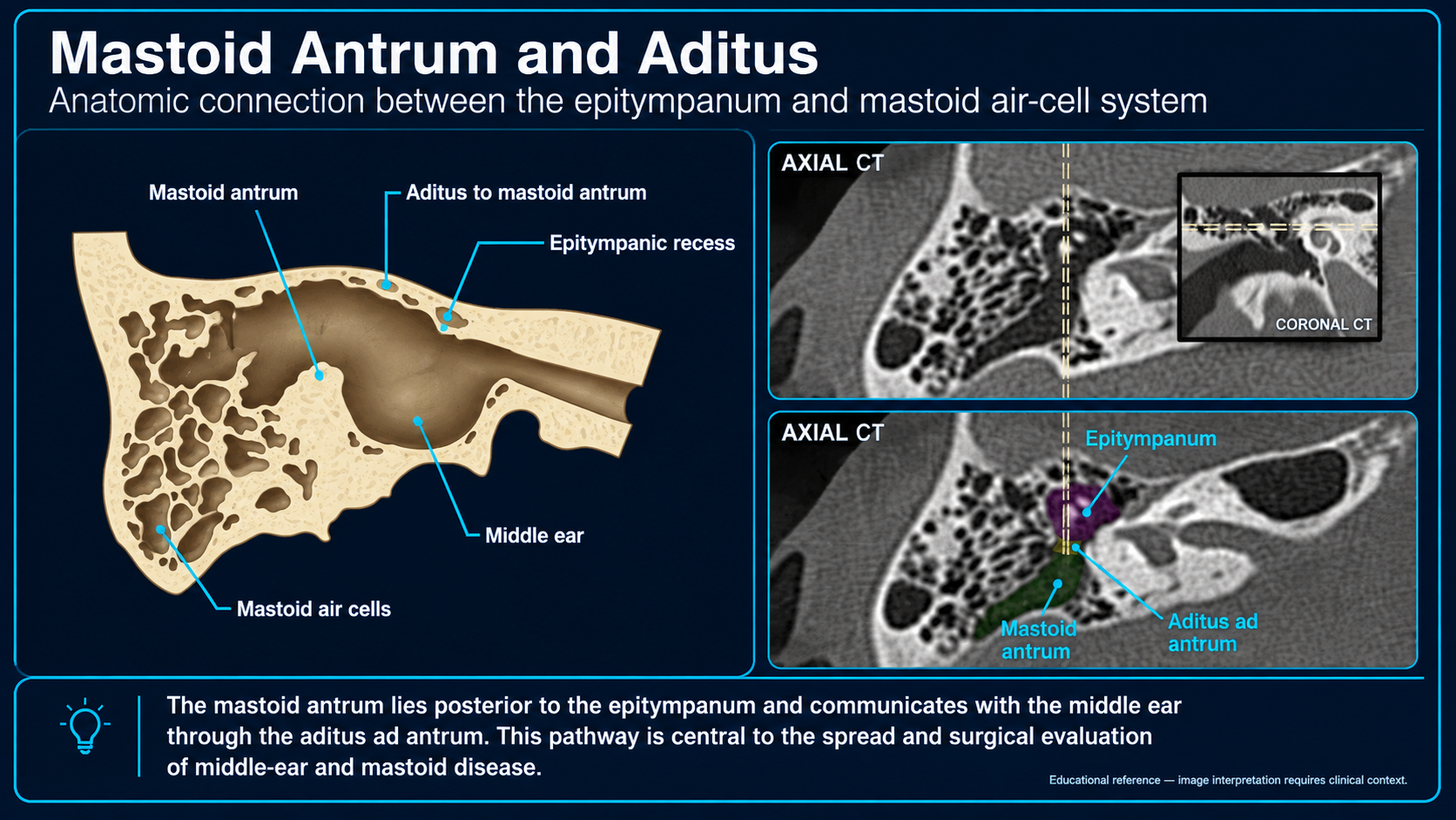 Mastoid antrum and aditus anatomy with CT correlation