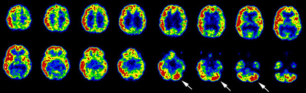 Diaschisis.JPG (61352 bytes)